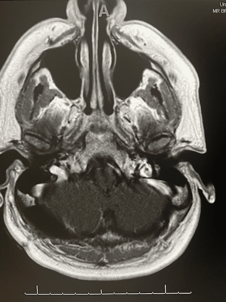 Cole's brain after treatment